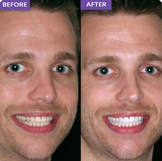 Whitening Strips- dentales púrpuras