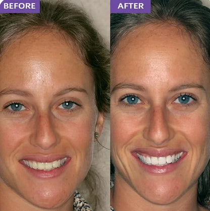 Whitening Strips- dentales púrpuras