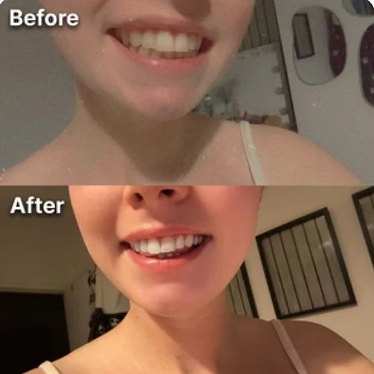 Whitening Strips- dentales púrpuras