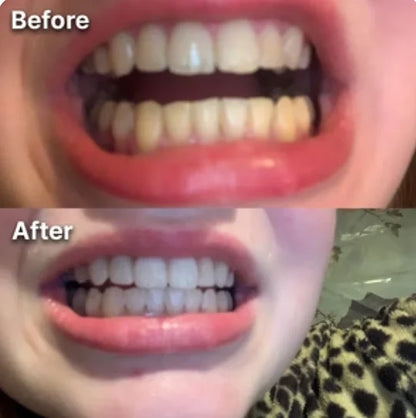 Whitening Strips- dentales púrpuras