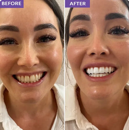 Whitening Strips- dentales púrpuras