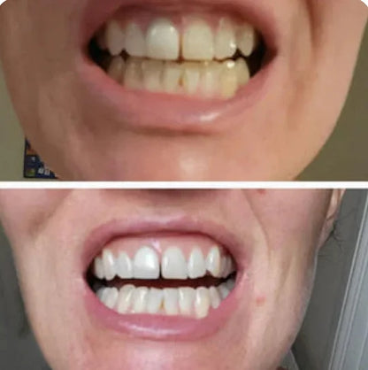 Whitening Strips- dentales púrpuras